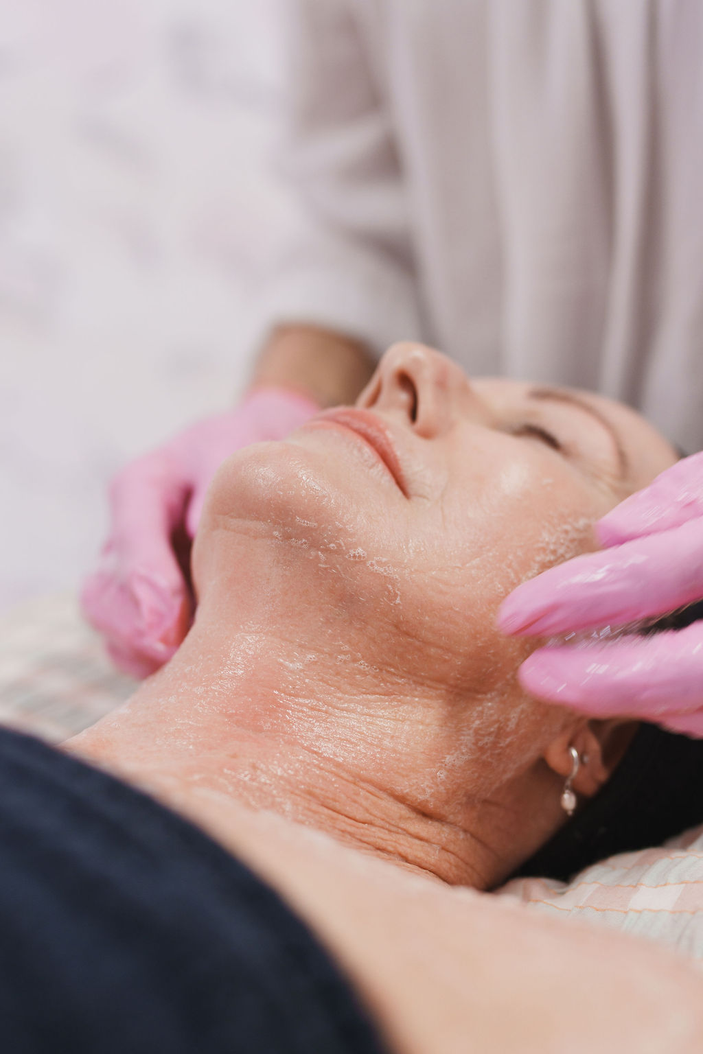 Professional Skin Peels