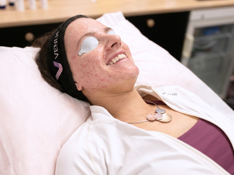 IPL for Acne-Prone Skin
