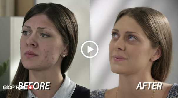 Skin clearing before and after