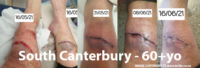 Leg wound healing before and after