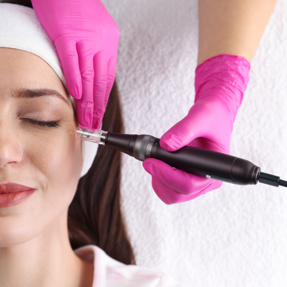 Microneedling treatment at Ablaze Aesthetics in Union, KY