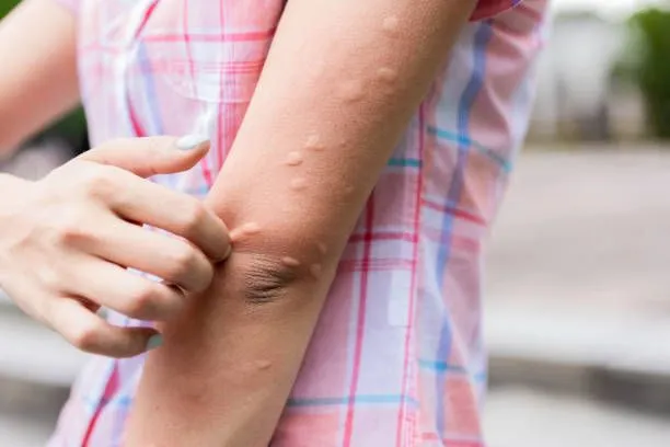 Mosquito bites on arm