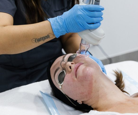 CO2 Aggressive Fractional Ablation