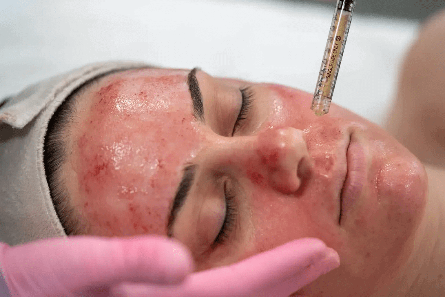 PRP Microneedling