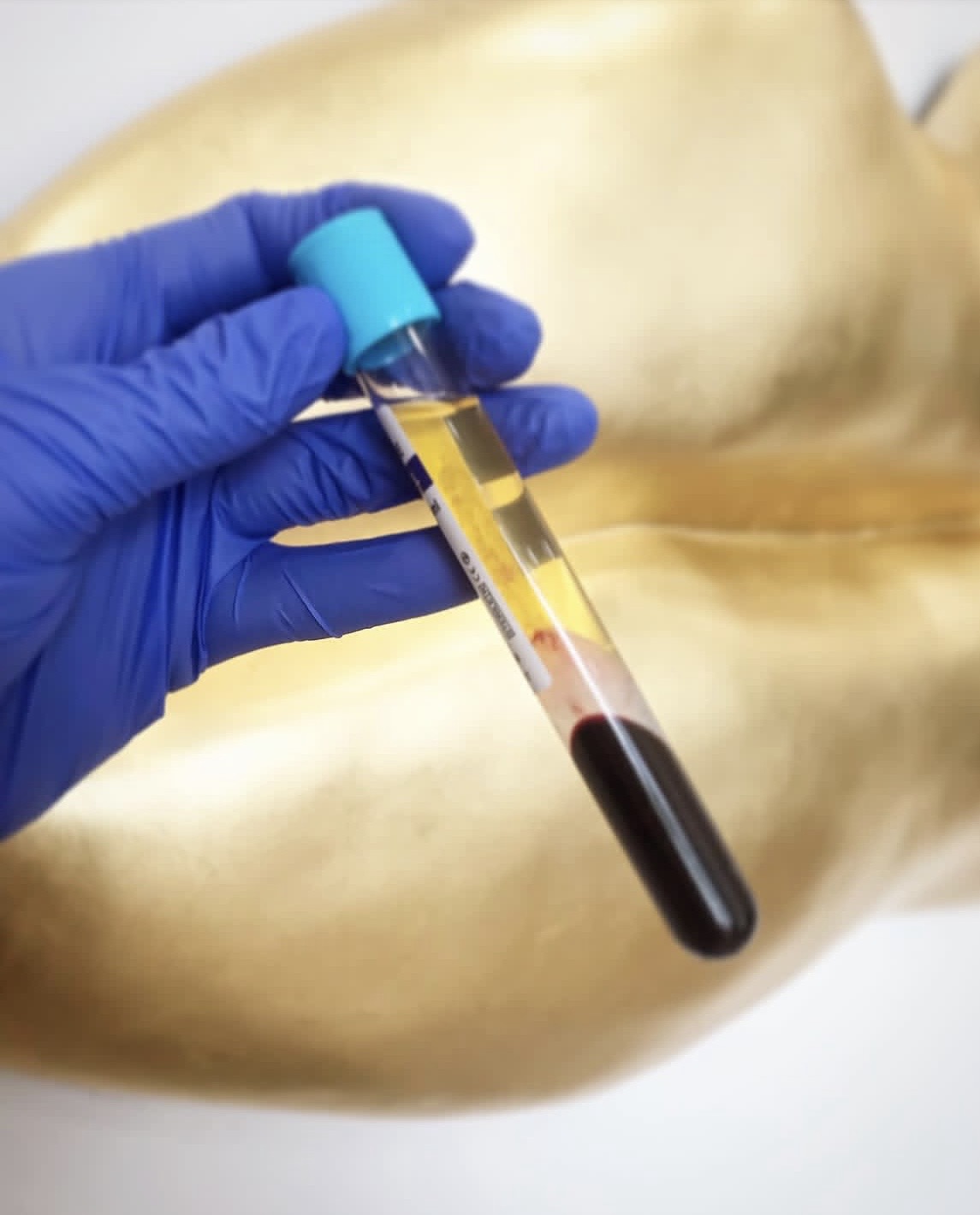 PRP (Vampire) Facial