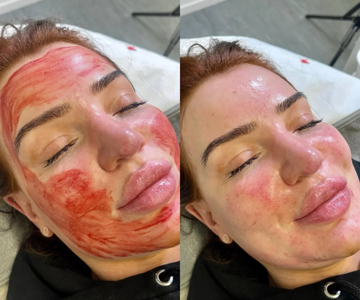 PRP (Vampire) Facial