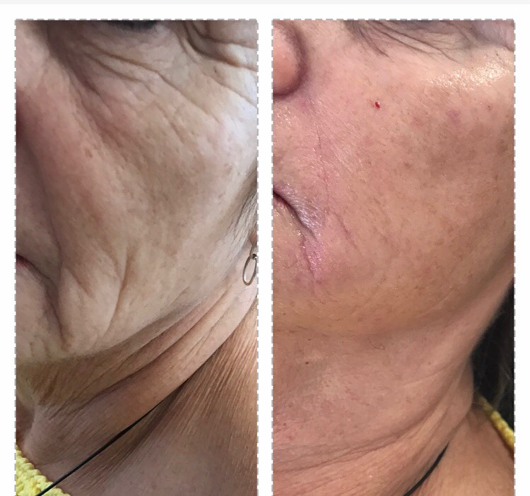 Skin Rejuvenation Before & After