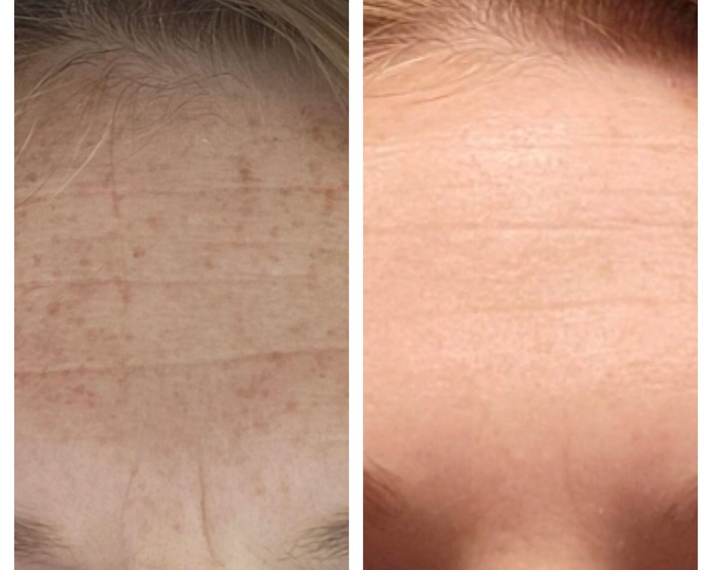 Forehead Smoothing & Texture Before & After