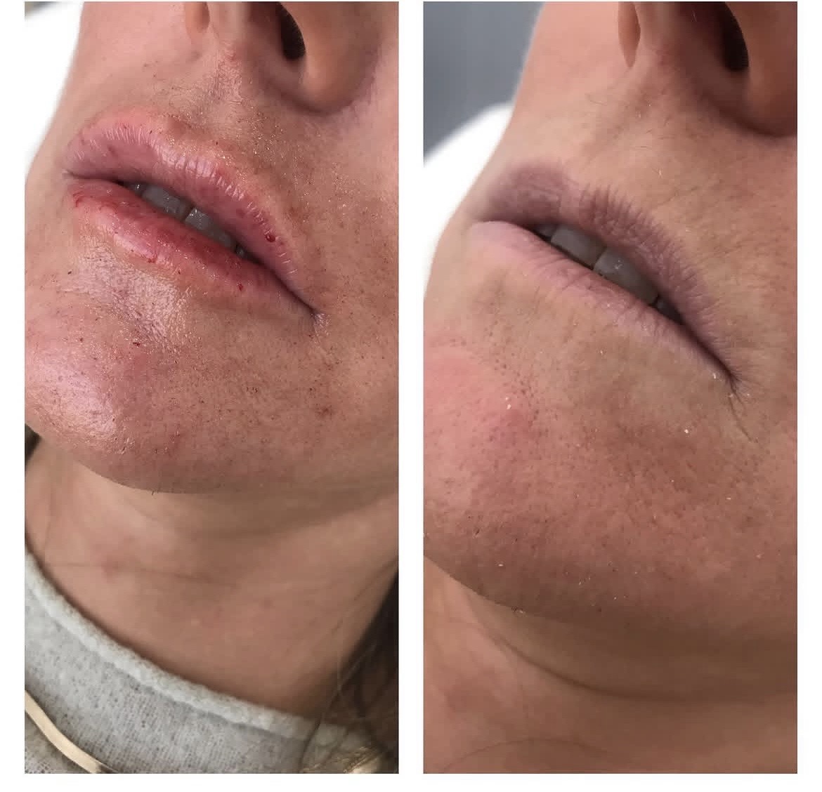 Cosmetic Injectables Before & After