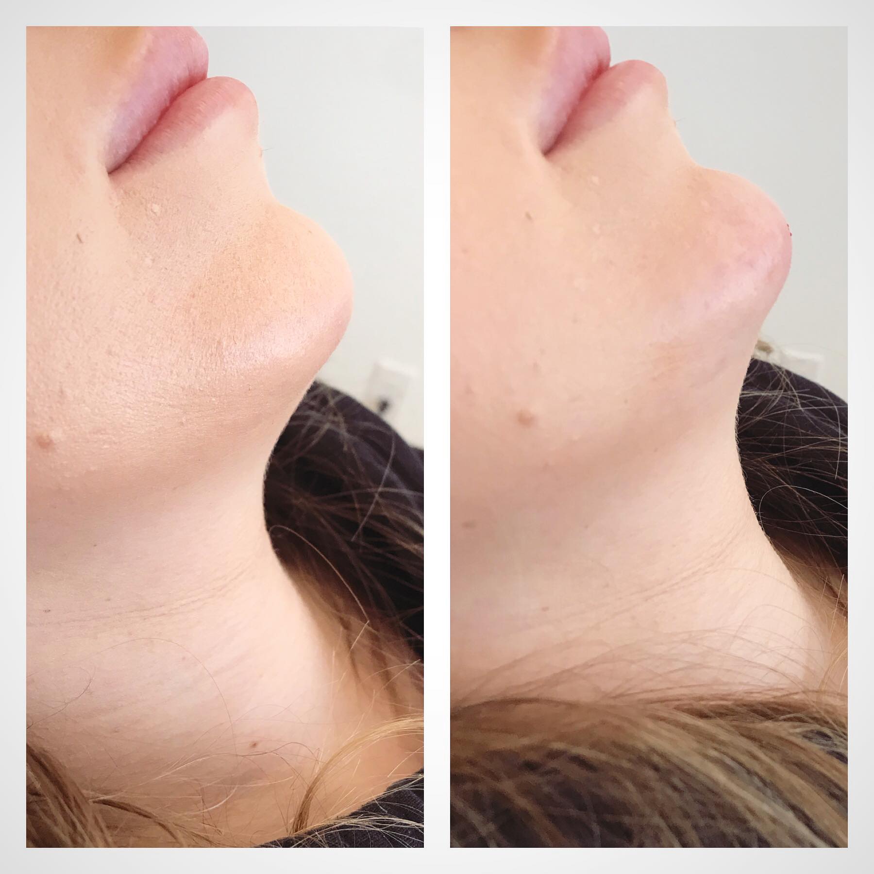 Chin & Jawline Contour Before & After