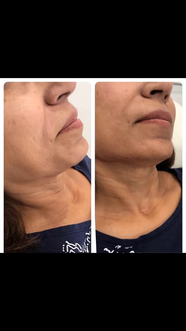Lower Face & Neck Rejuvenation Before & After
