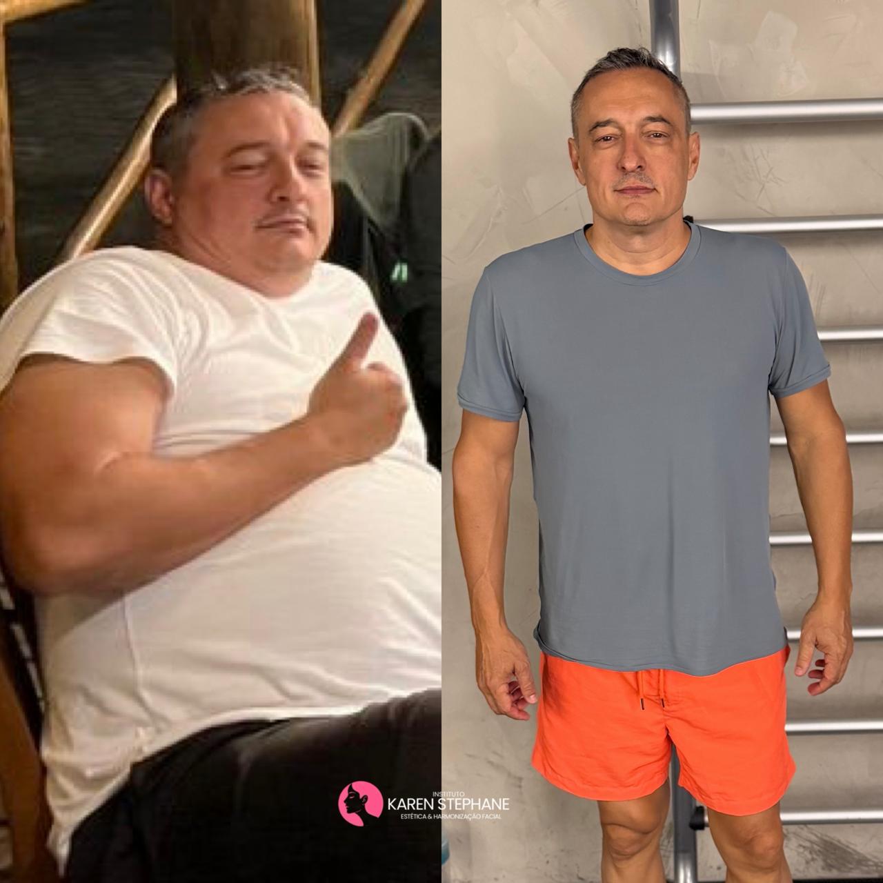 Antes e Depois de Tony