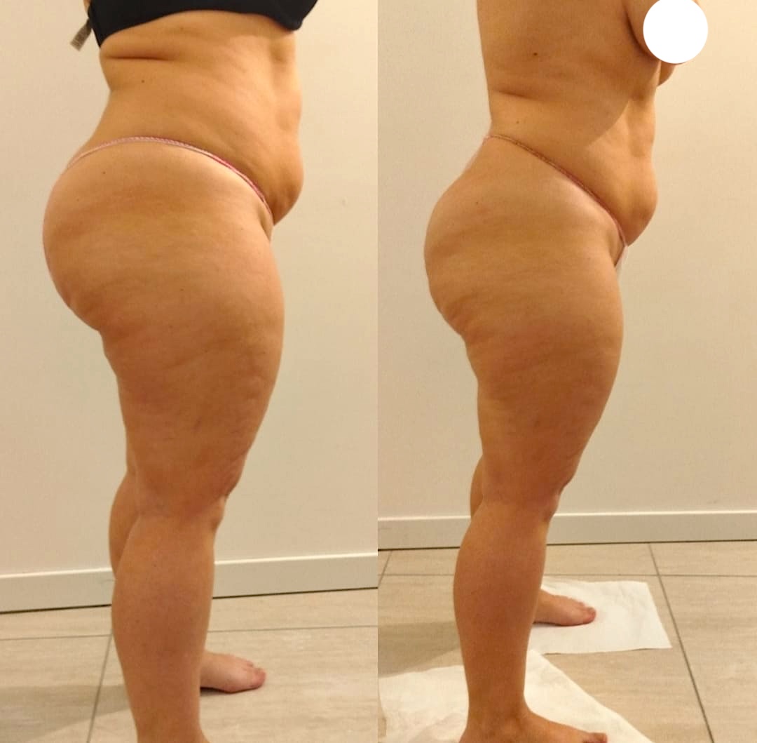 Prima e dopo Detox Gambe Settimo Senso Beauty – Risultato 1