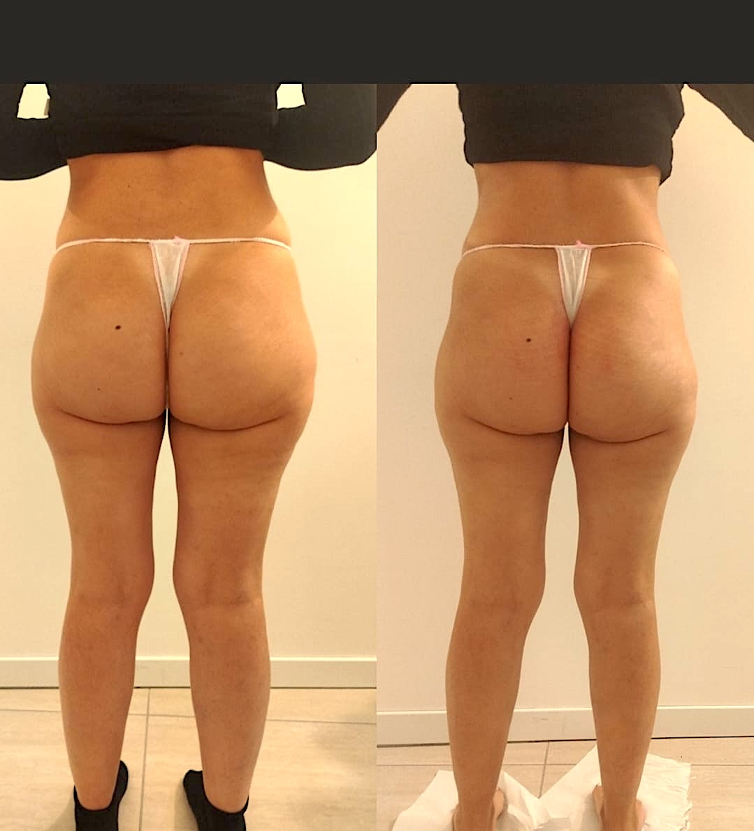 Prima e dopo Detox Gambe Settimo Senso Beauty – Risultato 3