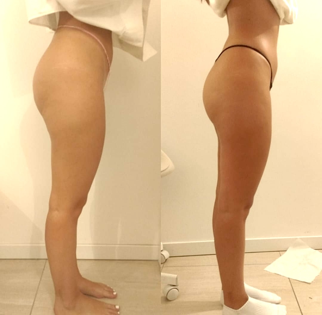 Prima e dopo Detox Gambe Settimo Senso Beauty – Risultato 2