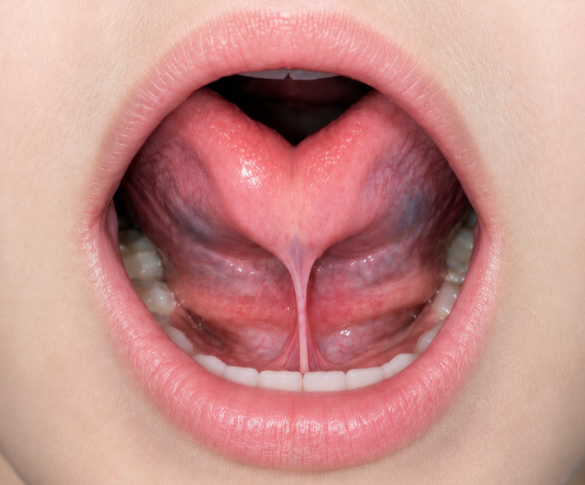 Before therapy - tongue tie visible