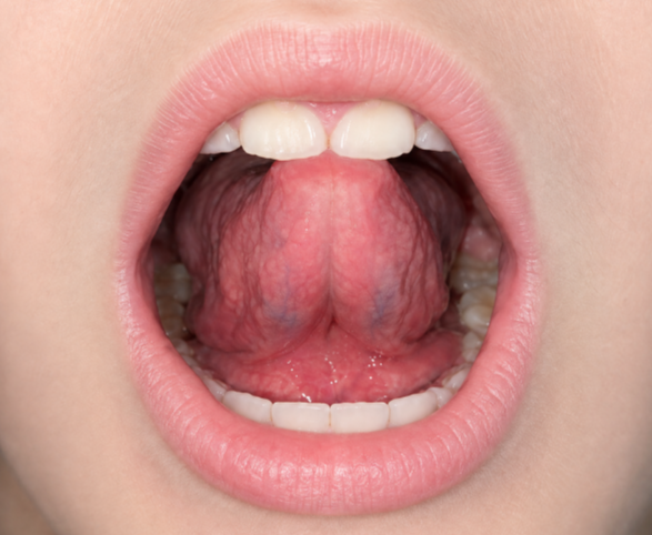 After therapy - improved tongue posture