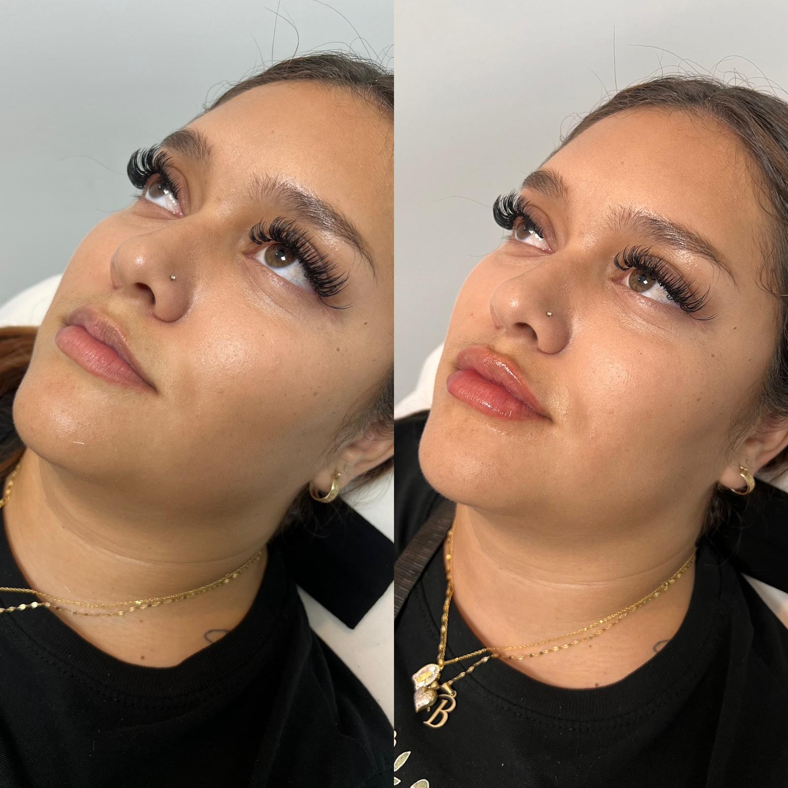 Lip Enhancement with Dermal Filler