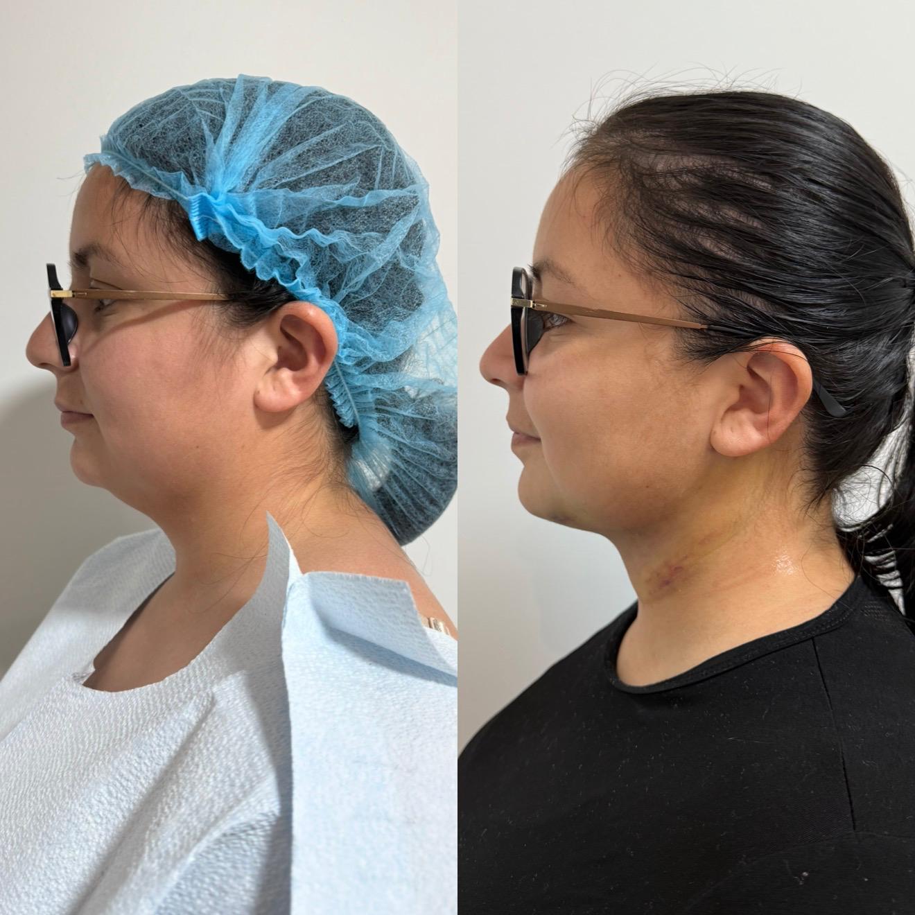 Submental Fat Reduction with Jawline Definition