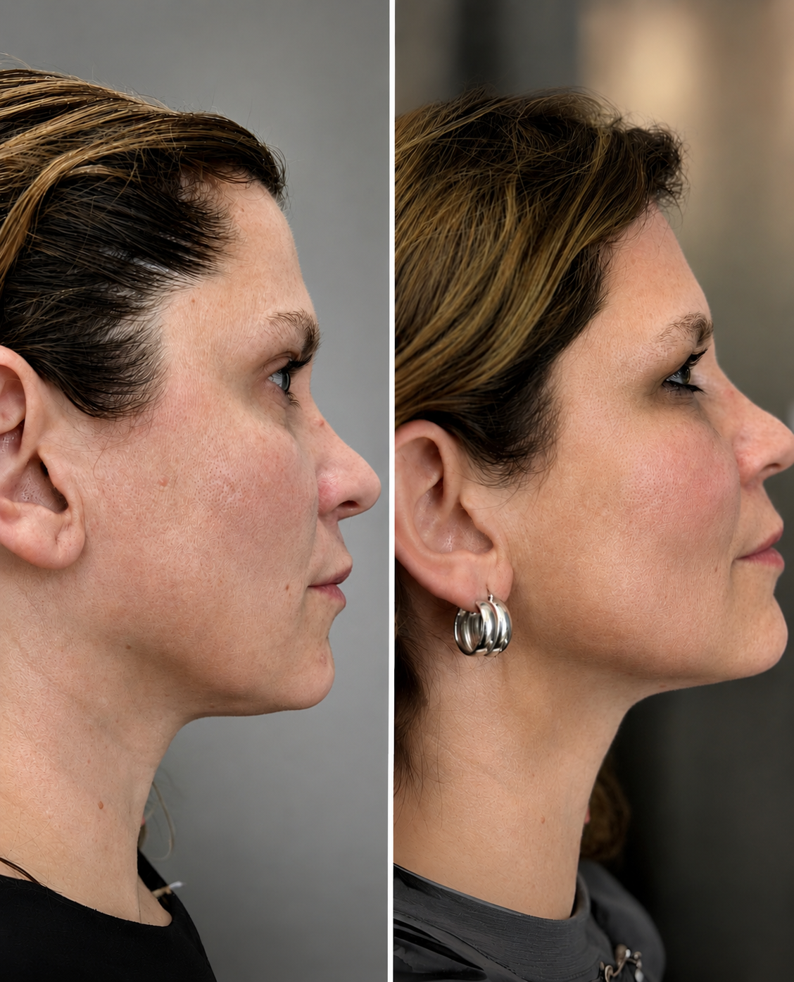 Endolift Facial