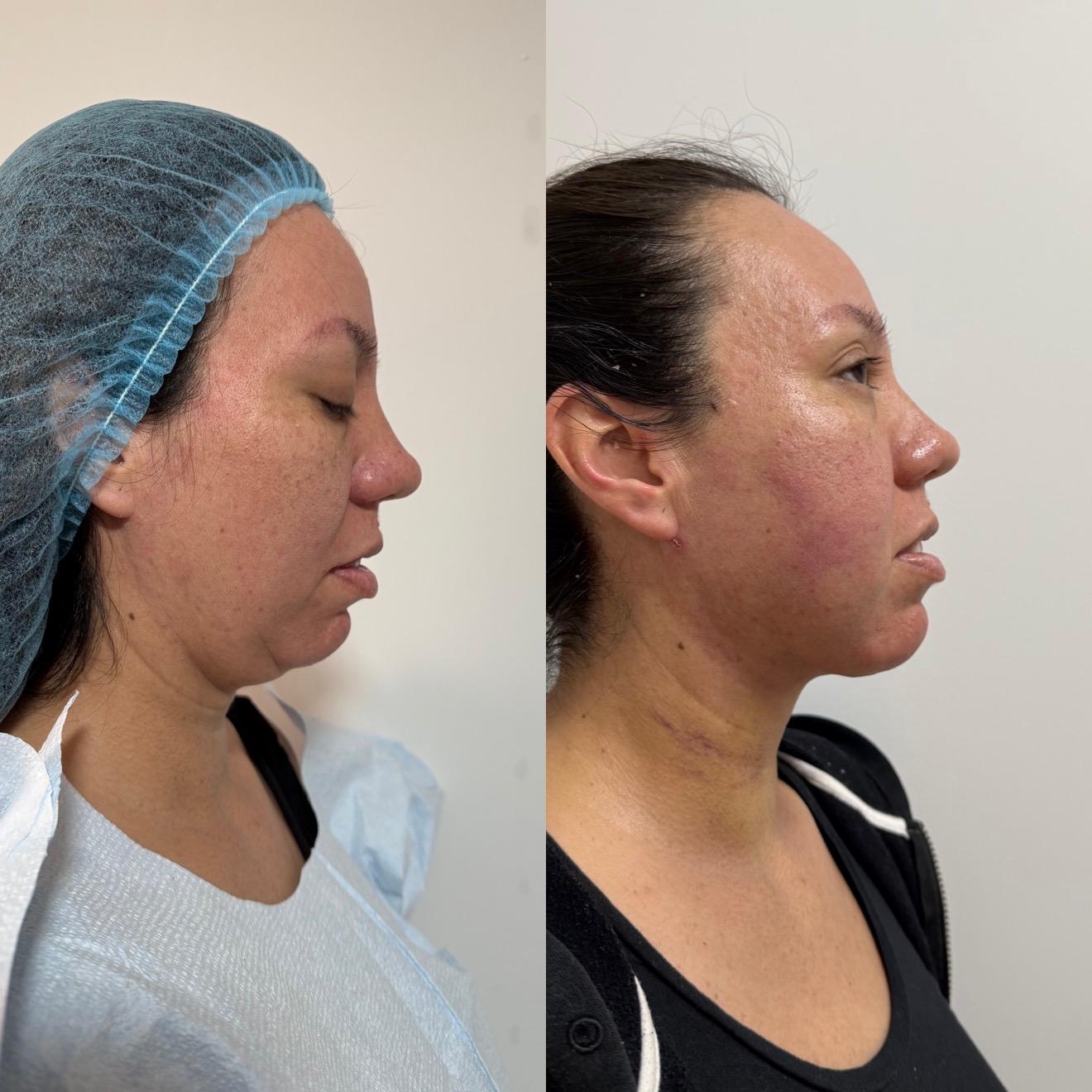 Endolift Facial & Chin Lipo with Jaw Contouring