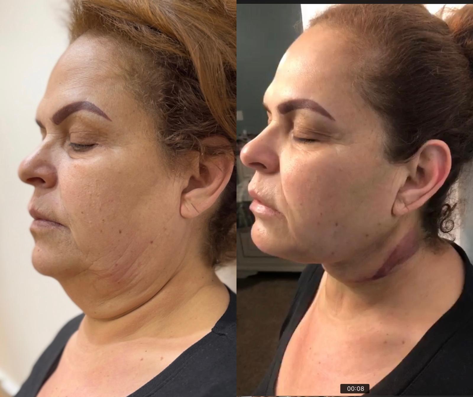 Endolift Facial + Submental Fat Reduction with Jawline Definition