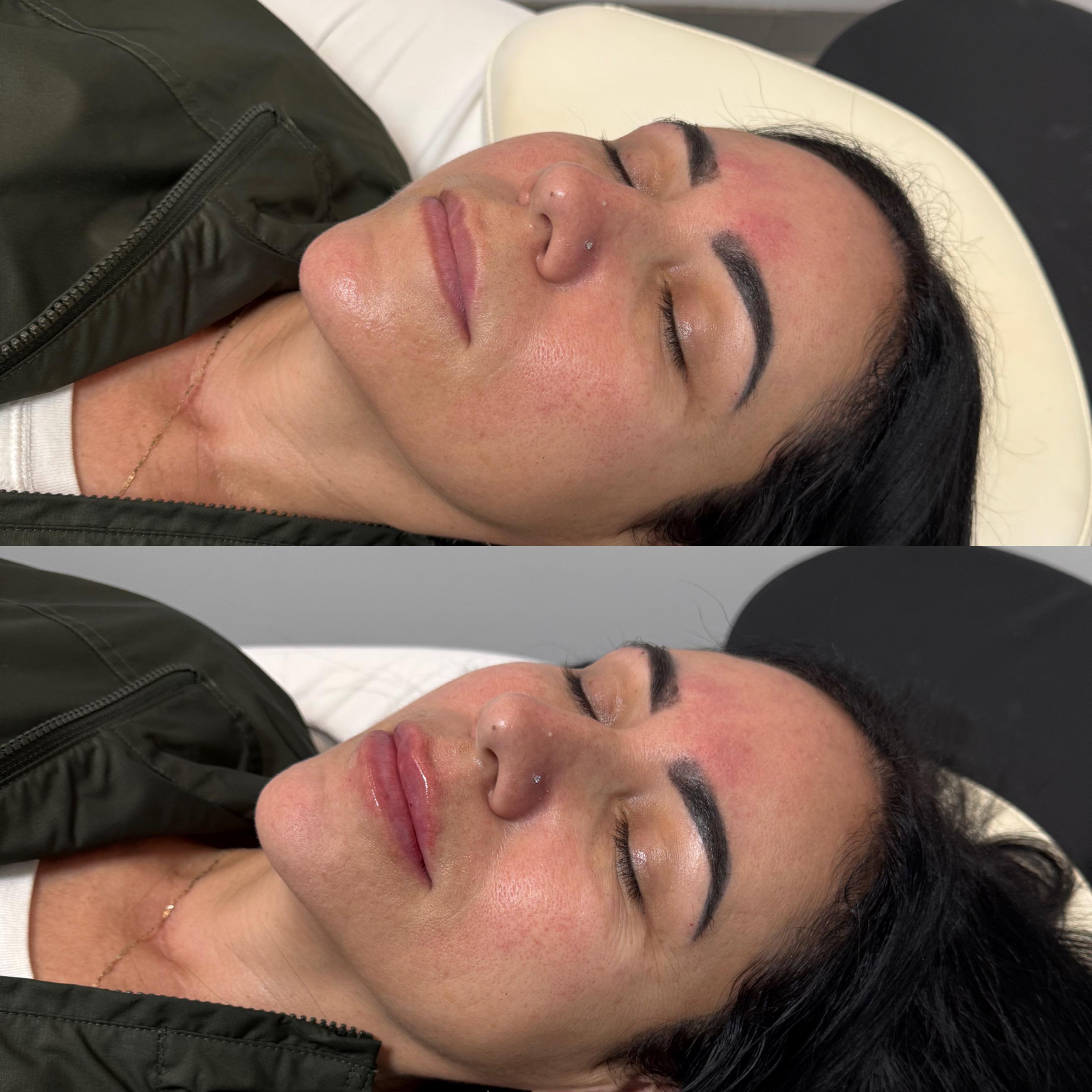 Lip Enhancement with Dermal Filler
