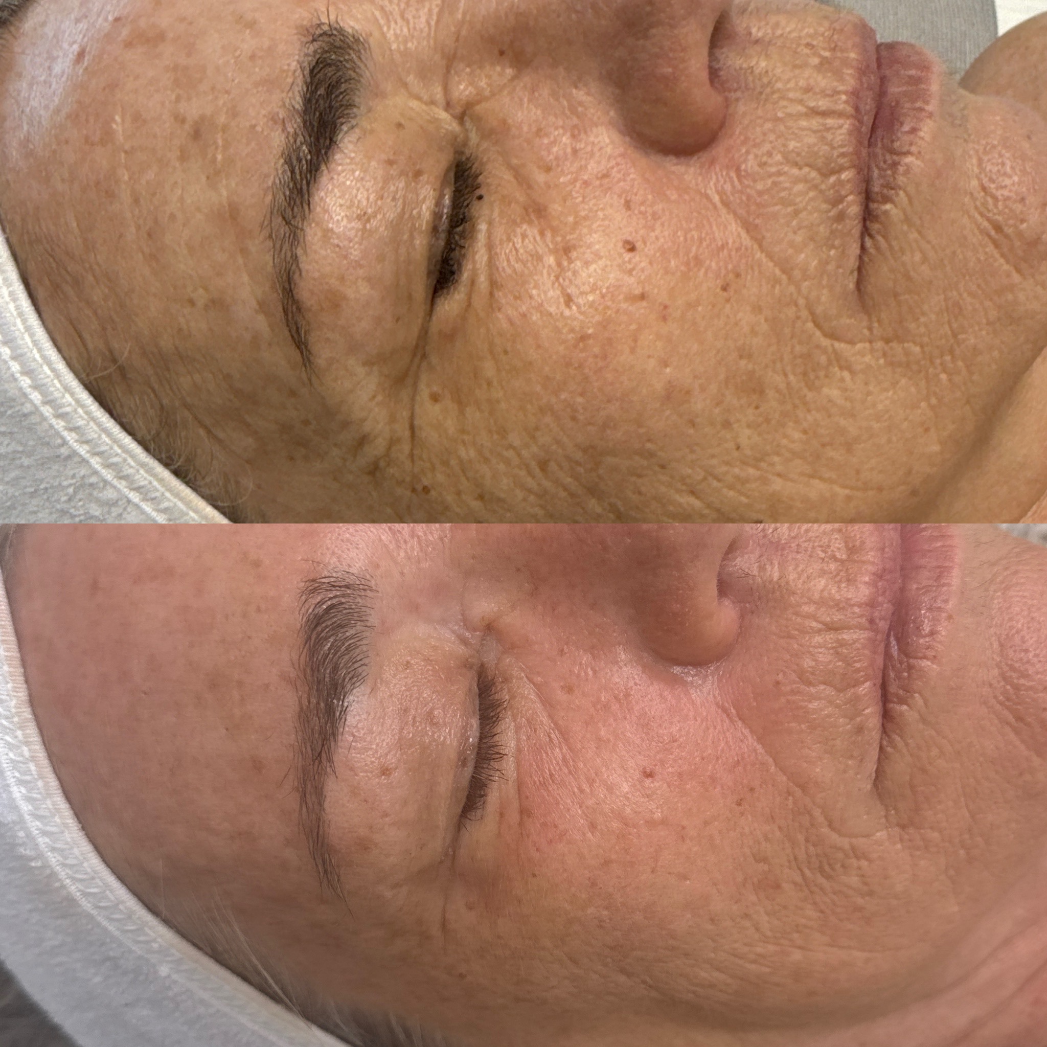 Fine lines & skin texture