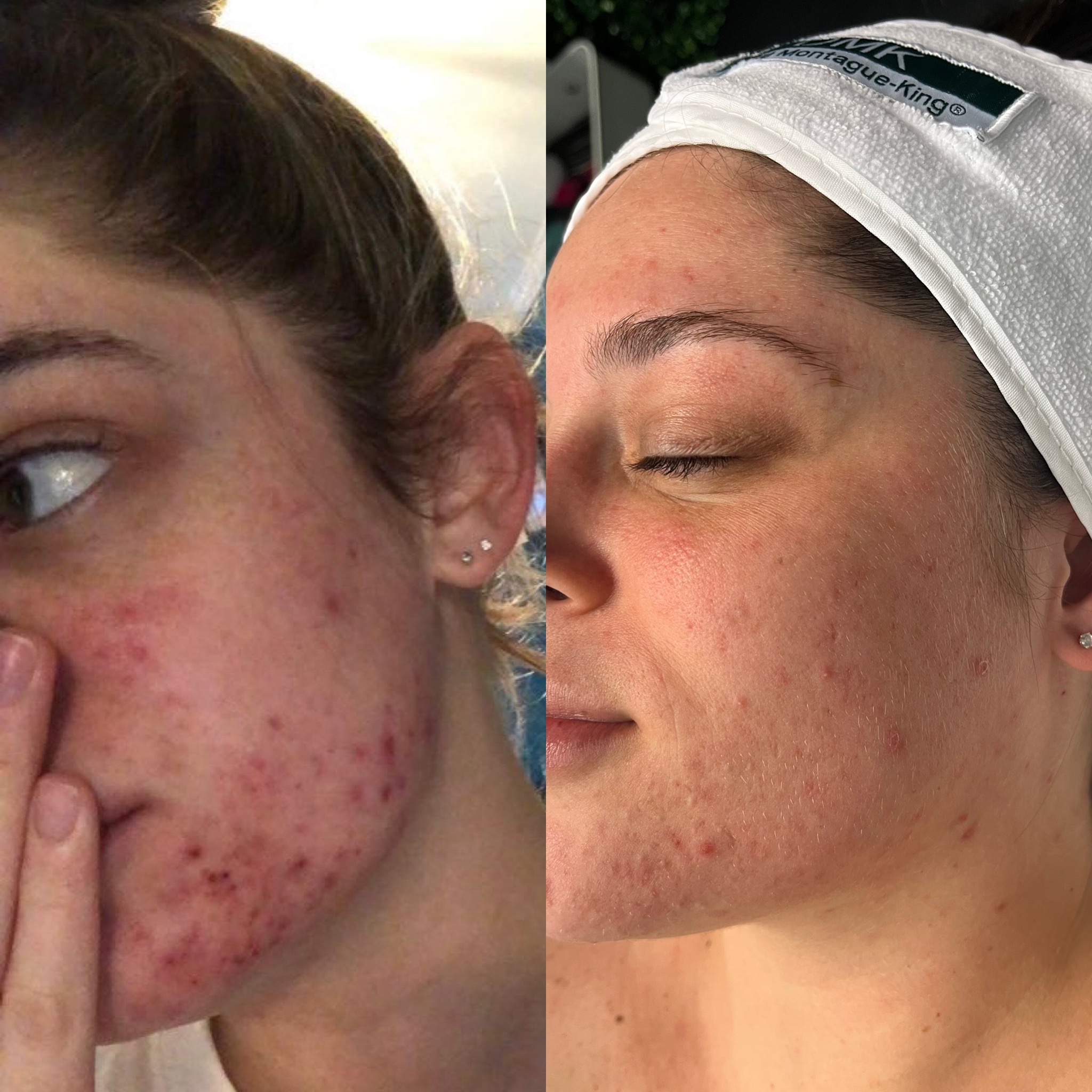 Breakouts & redness