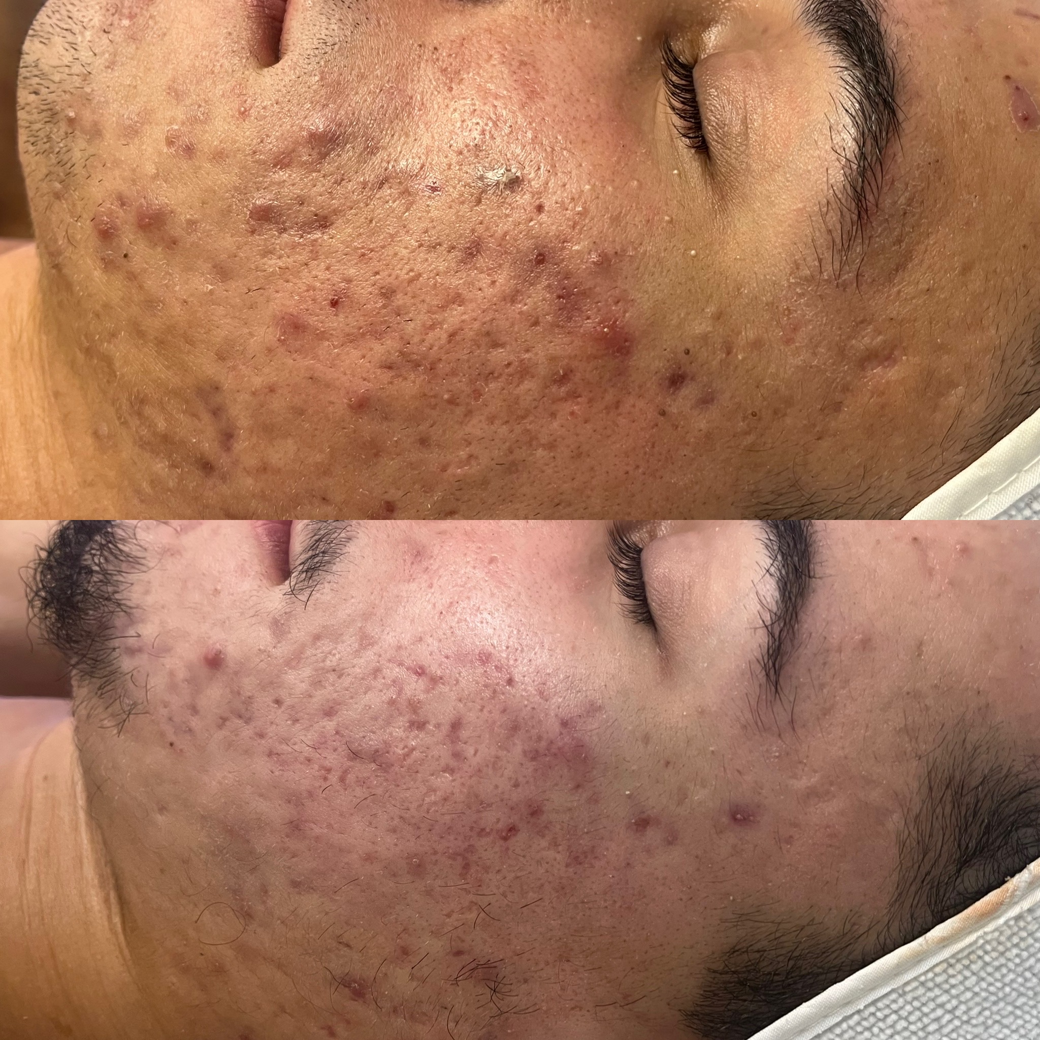 Active acne & congestion