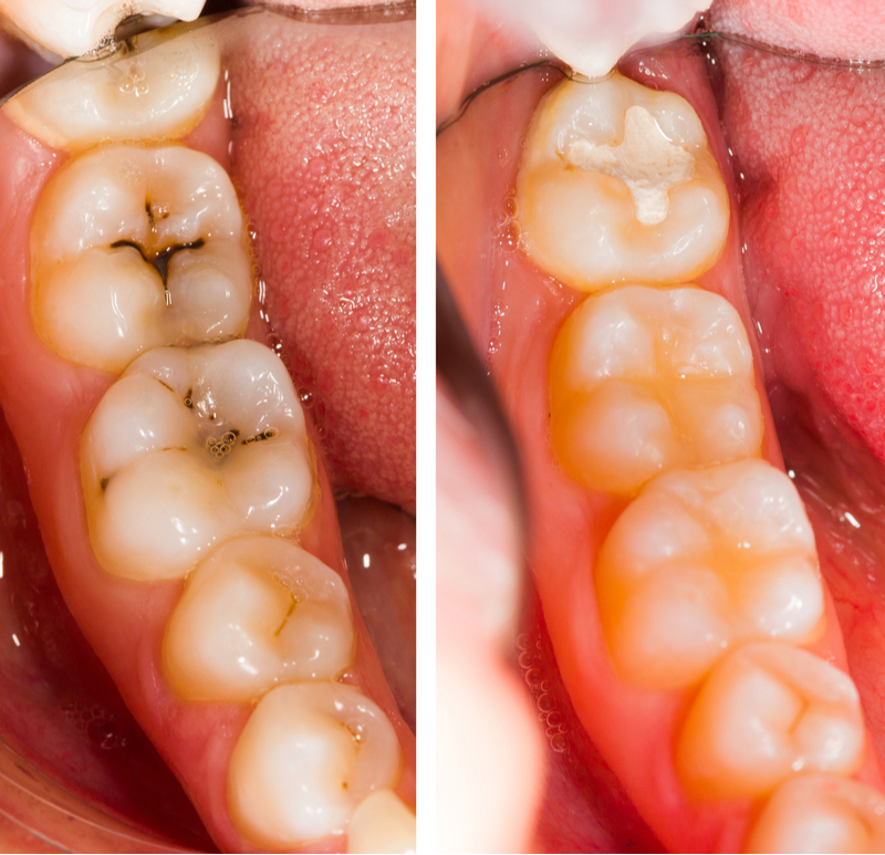 Composite Fillings