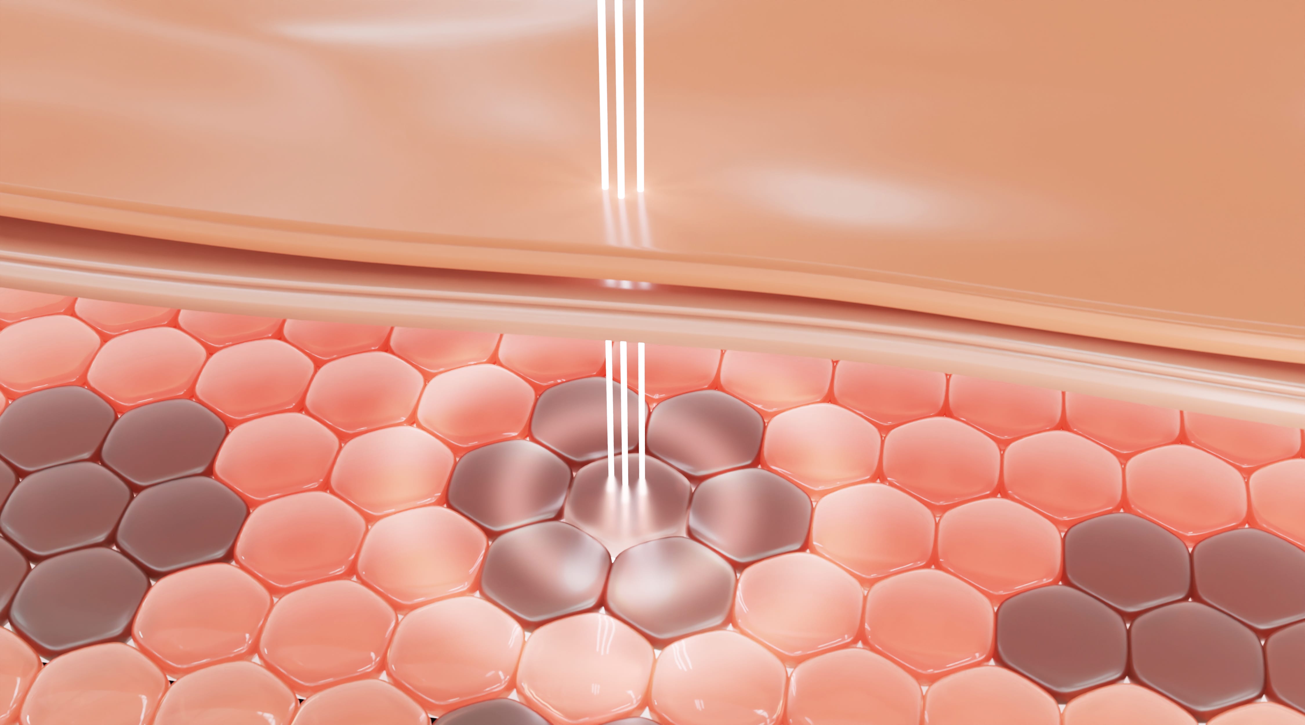 Advanced collagen laser treatment at Advanced Aesthetics Medical Spa Overland Park KS