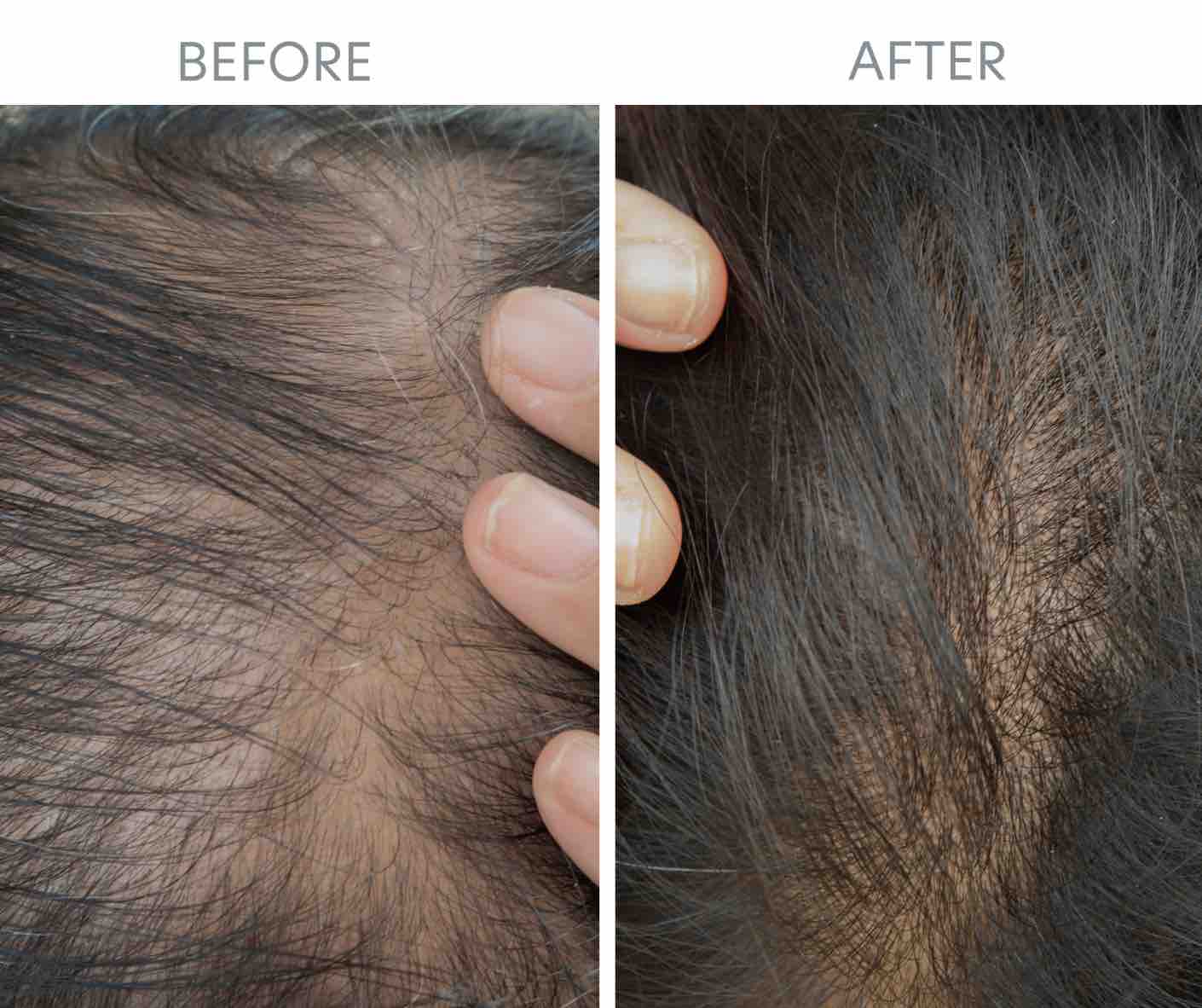 PRP Hair Restoration Before & After