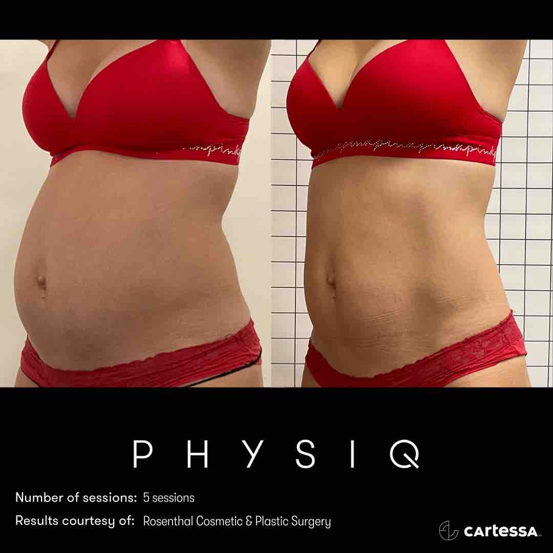 PHYSIQ body contouring treatment for women at Advanced Aesthetics Medical Spa Overland Park KS