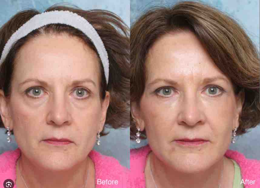 Sculptra Before and After