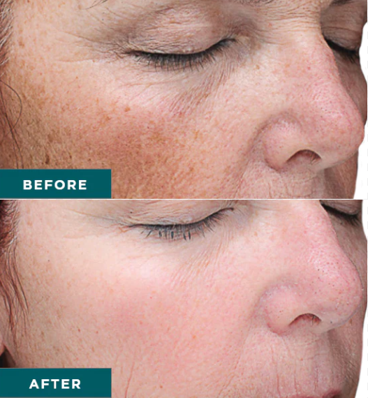 Chemical Peels Before & After