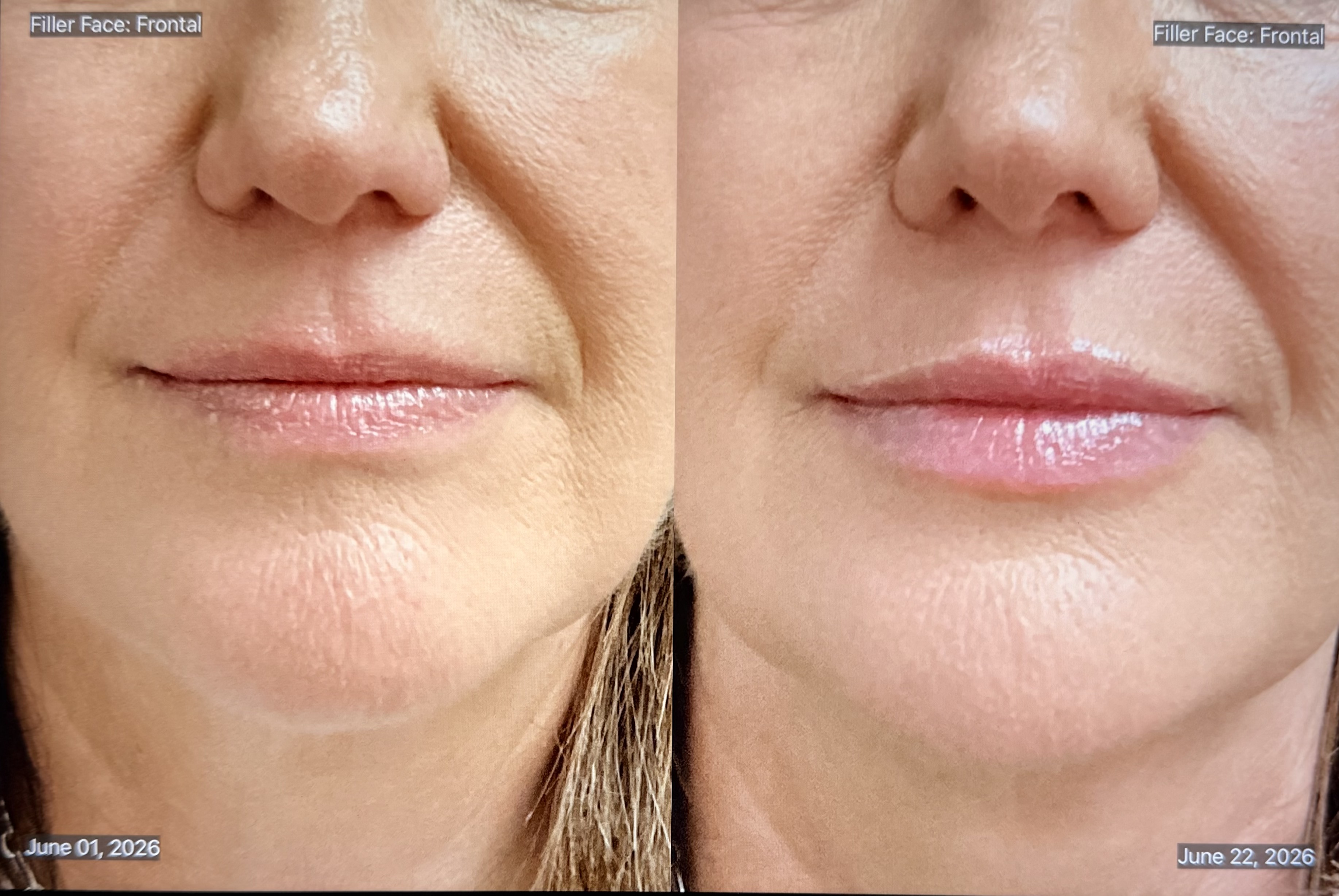 Dermal Filler Before and After Frontal