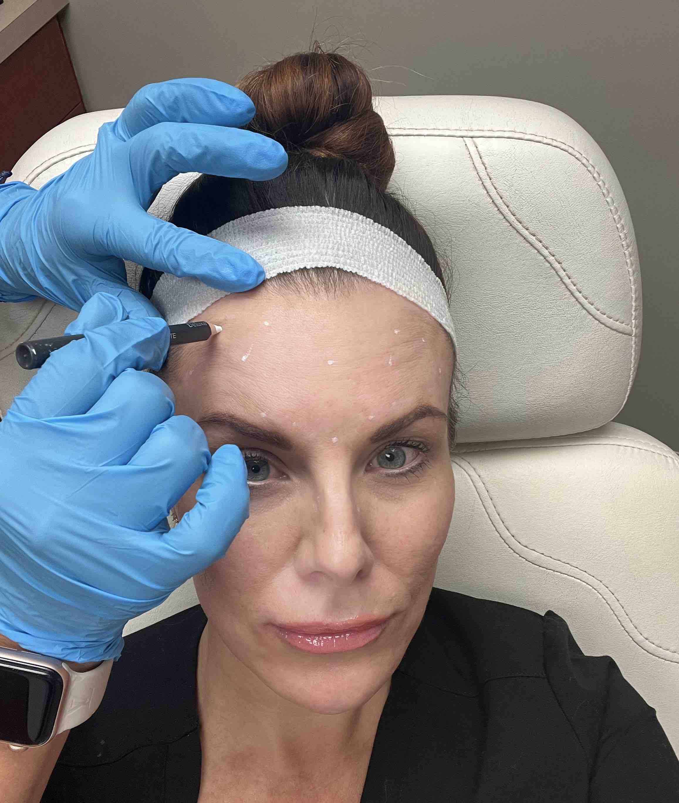 Neurotoxin Botox treatment results at Advanced Aesthetics Medical Spa in Overland Park KS