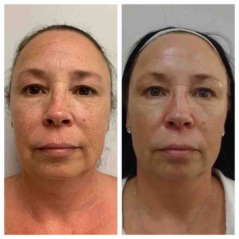 Sublative Skin Resurfacing Before & After