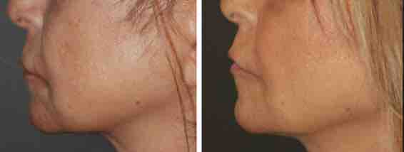 Body Tightening Before & After