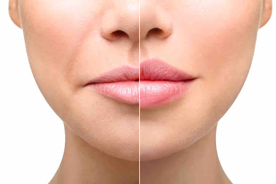 Lip Filler Before and After
