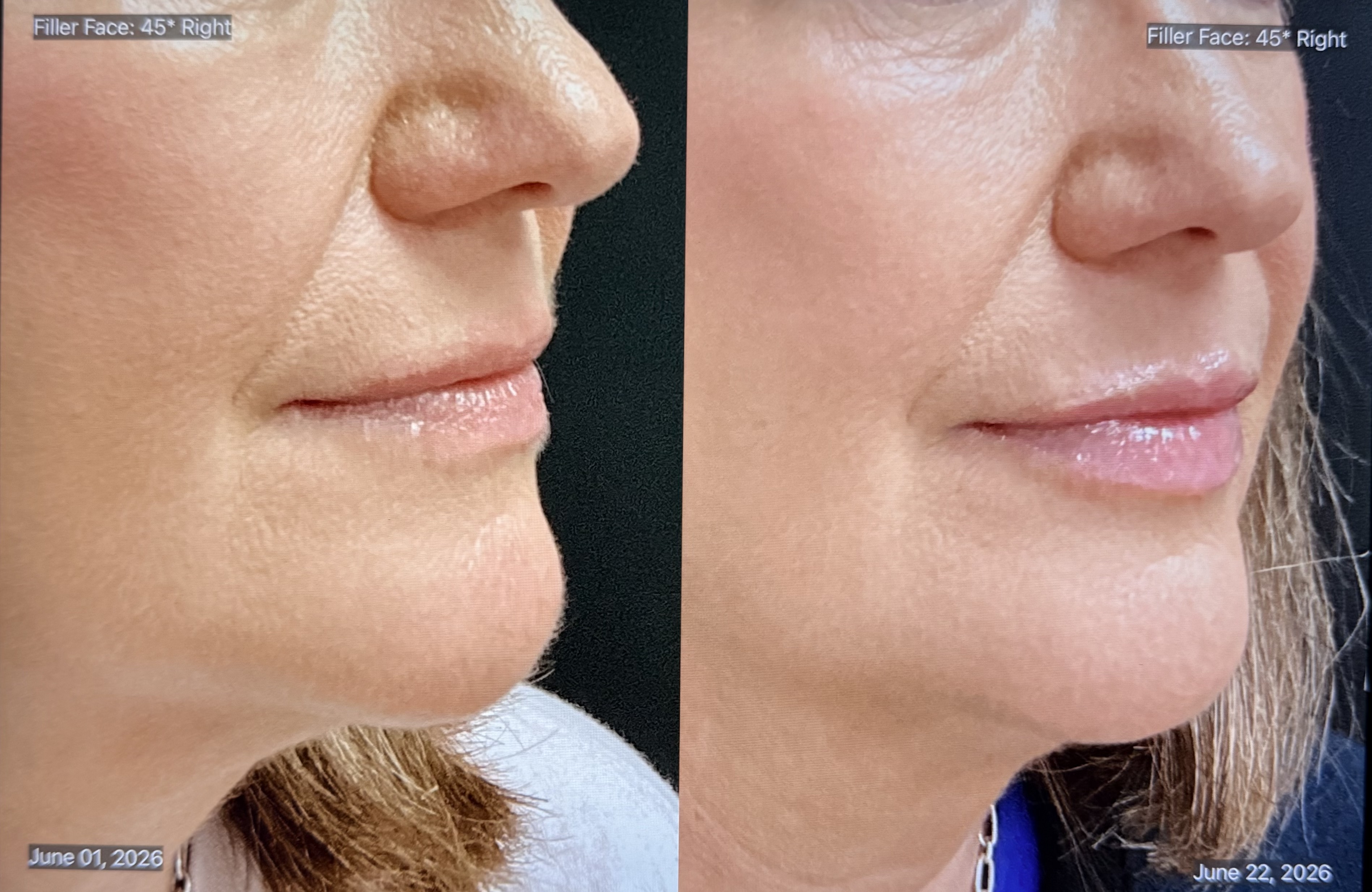 Dermal Filler Before and After Right Profile