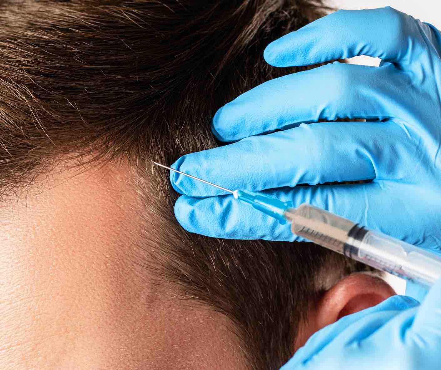 PRP Hair Restoration