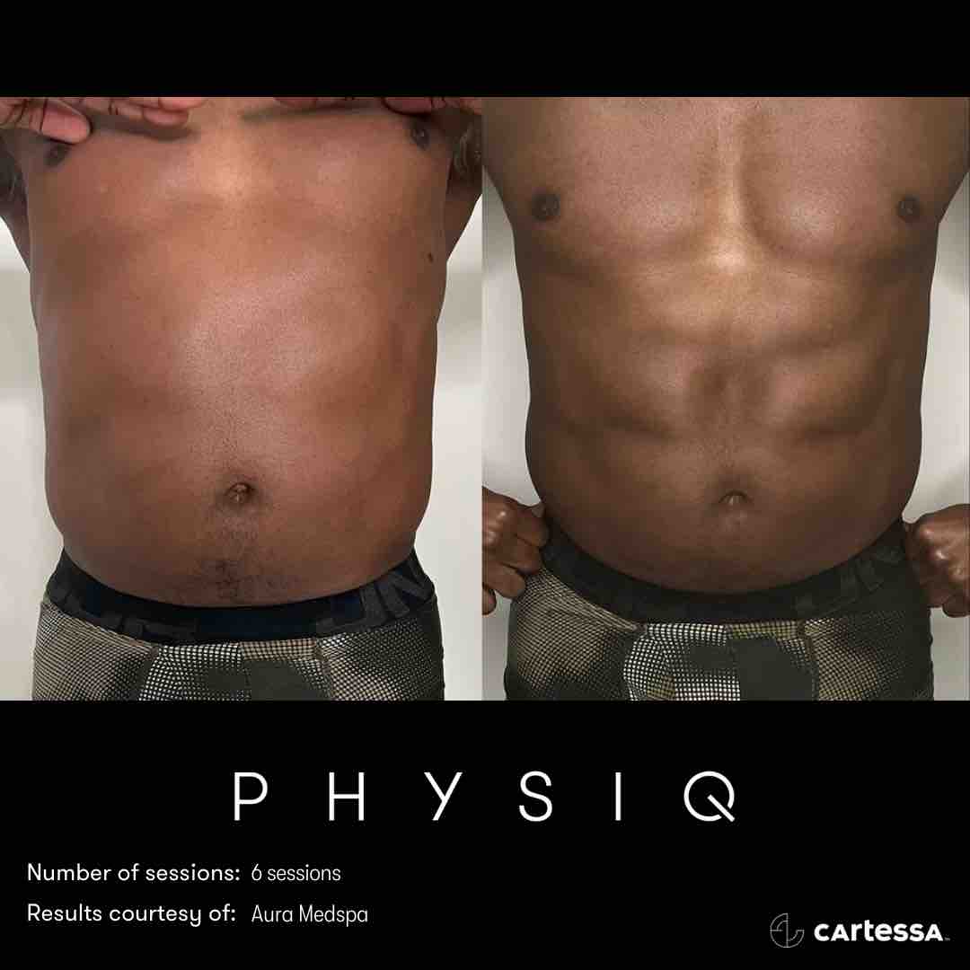 Body Contouring