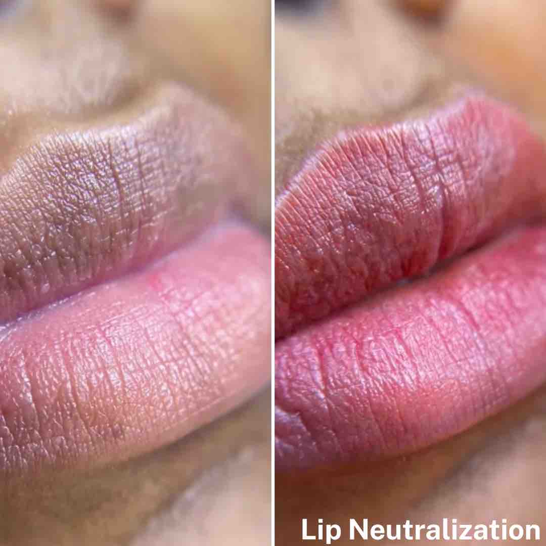 Lip Neutralization Before & After
