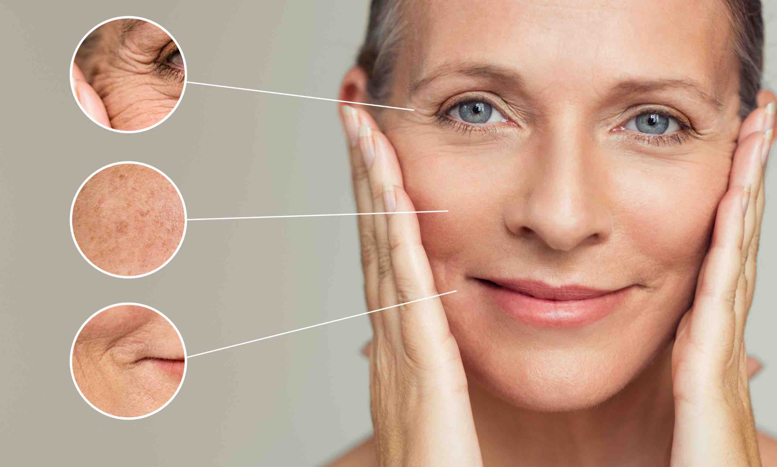 Sublative skin resurfacing treatment at Advanced Aesthetics Medical Spa Overland Park KS