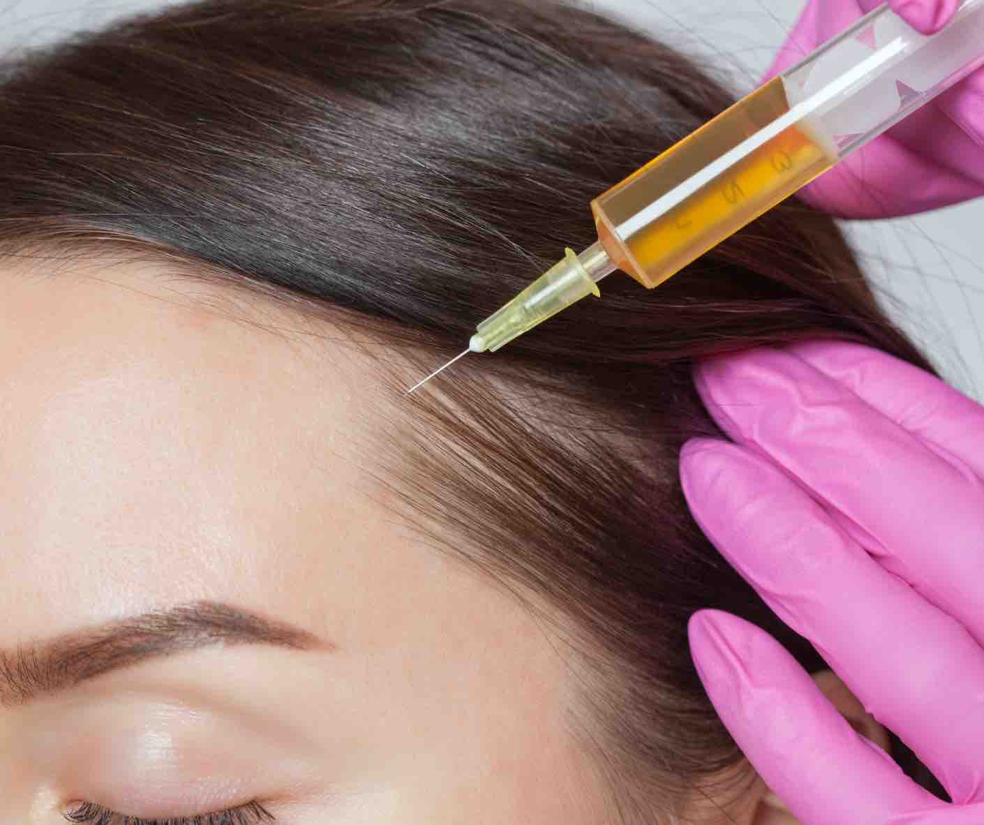 PRP hair restoration treatment at Advanced Aesthetics Medical Spa