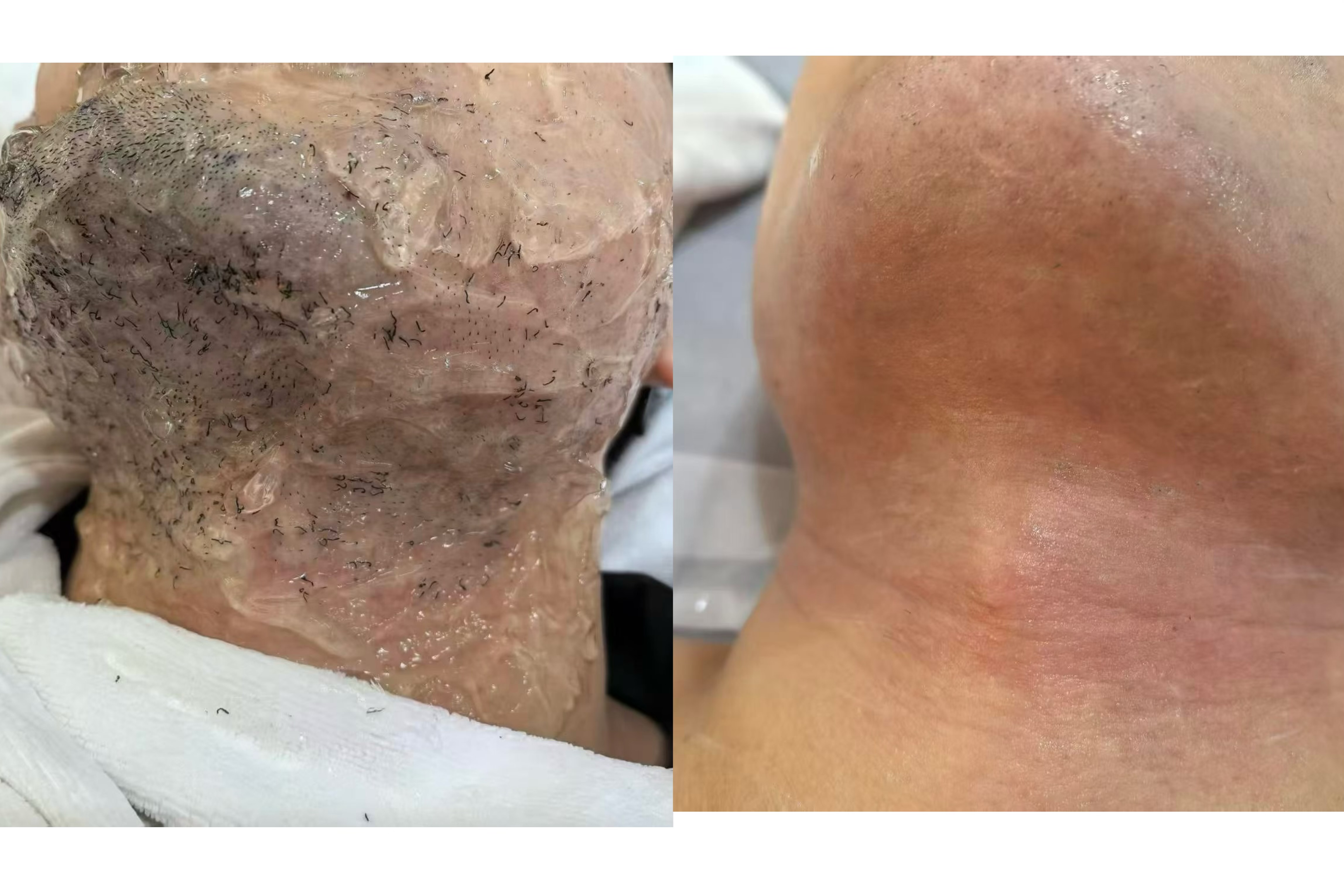 Clean skin hair removal treatment and results