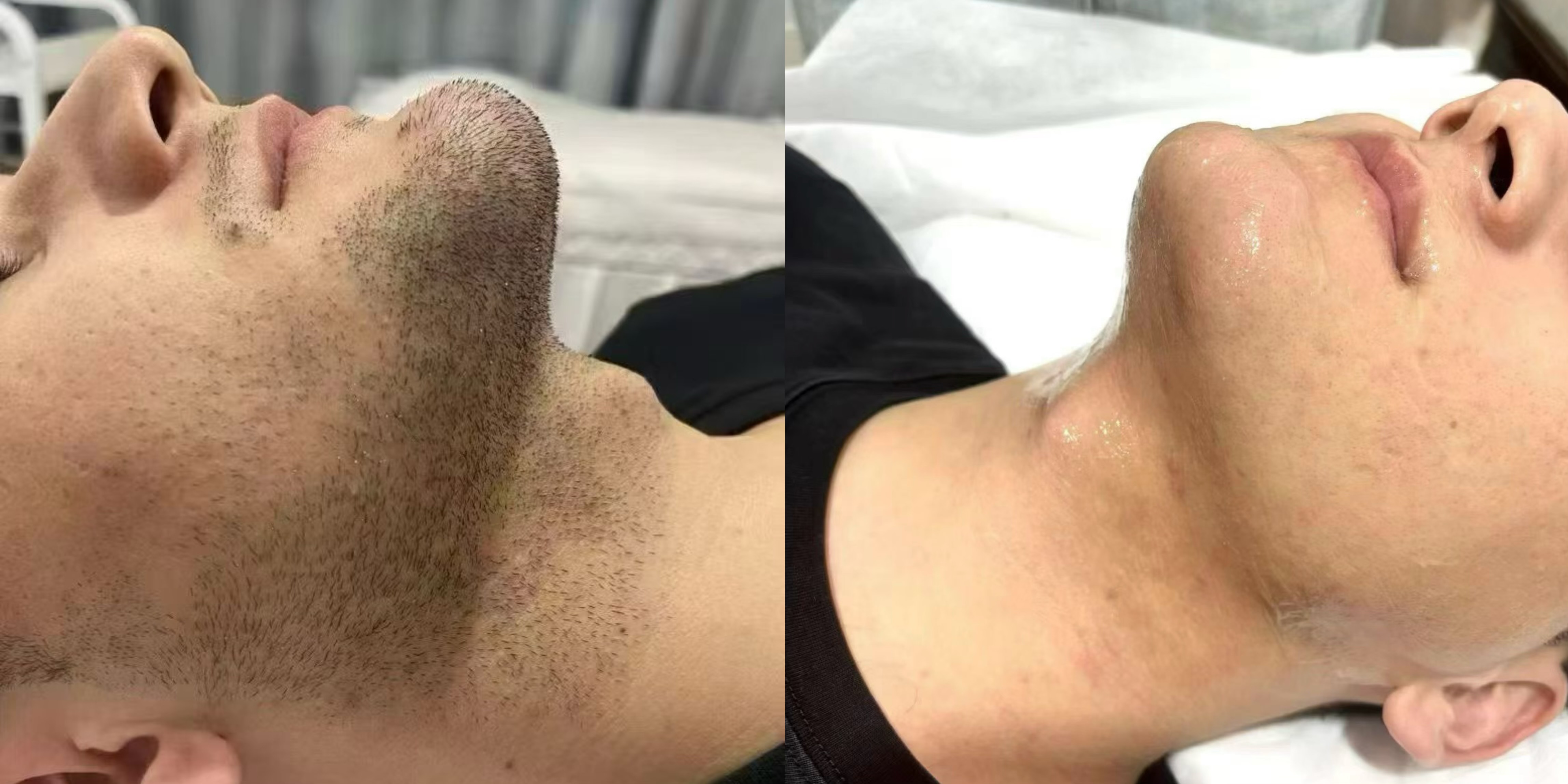 Beard and neck hair removal before and after results