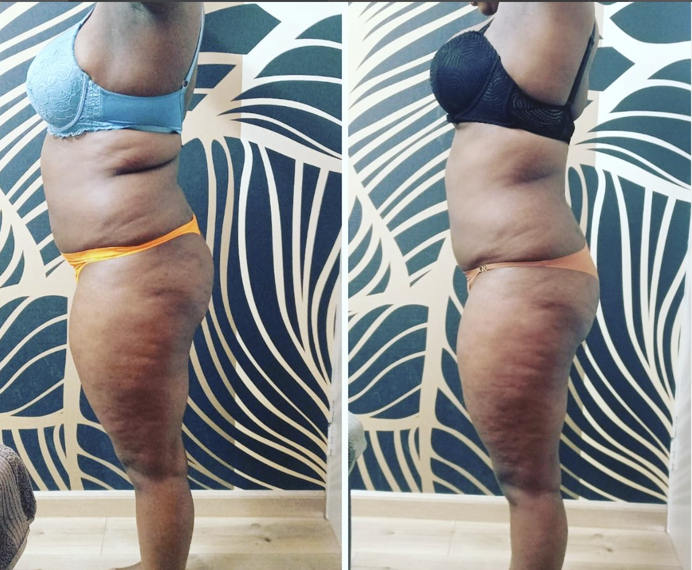 Thigh & Hip Definition